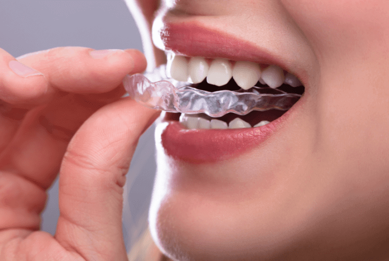 Teeth Grinding and Clenching Causes & Solutions invisible braces
